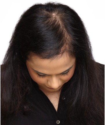 Non Surgical Hair Loss Treatment Clinic For Women in Manchester | Hair  Growth Studio