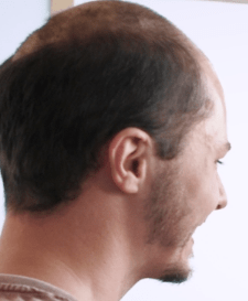 Hair Systems Manchester - Hair Loss Clinic - Non Surgical Hair Replacement